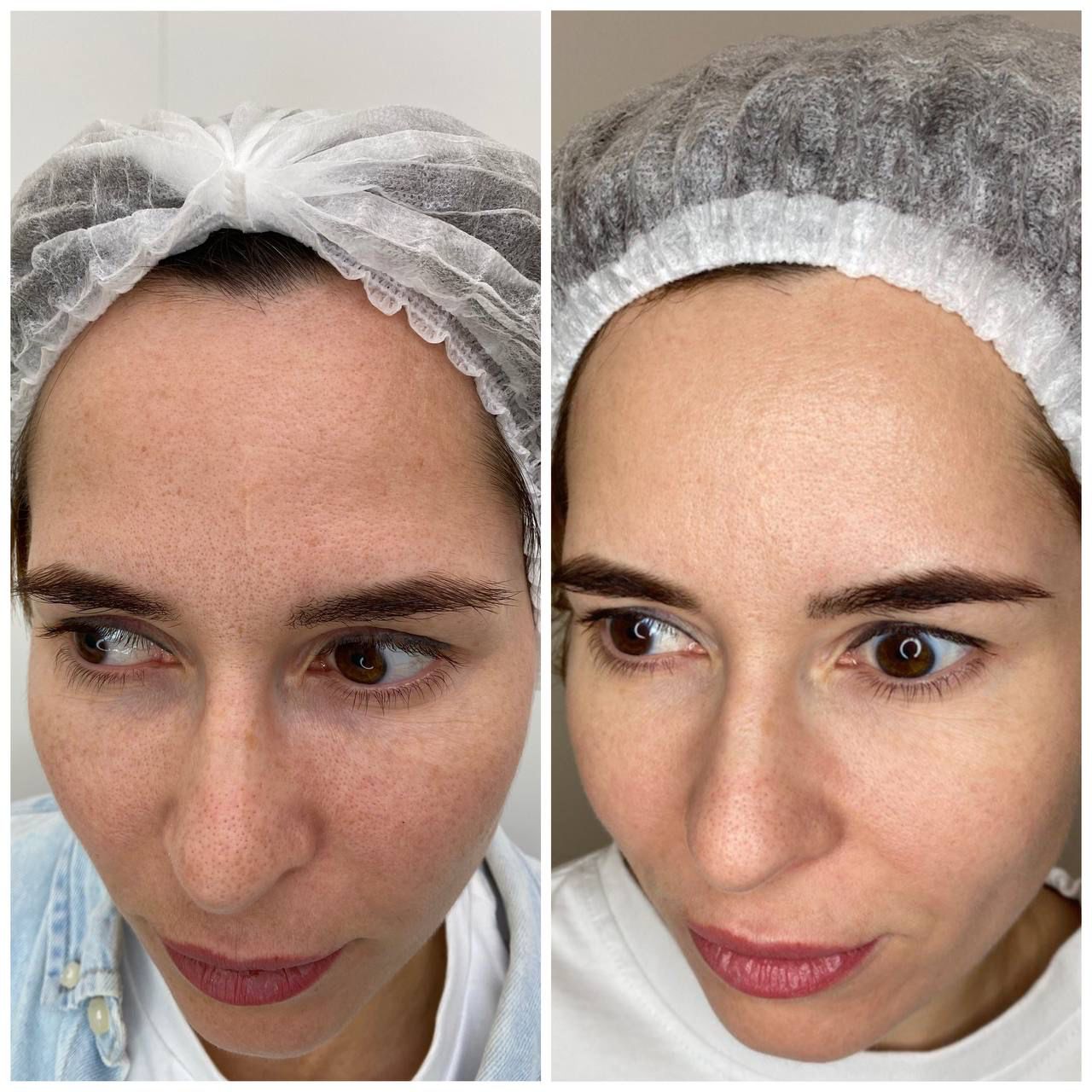 Фраксель для лица: цена в Москве на фракционное лазерное омоложение и ...